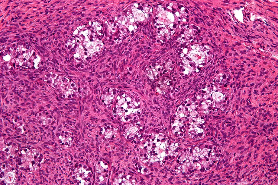 IL-17 Study Identifies Ovarian Clear Cell Cancer Subset That May Benefit From Immunotherapy